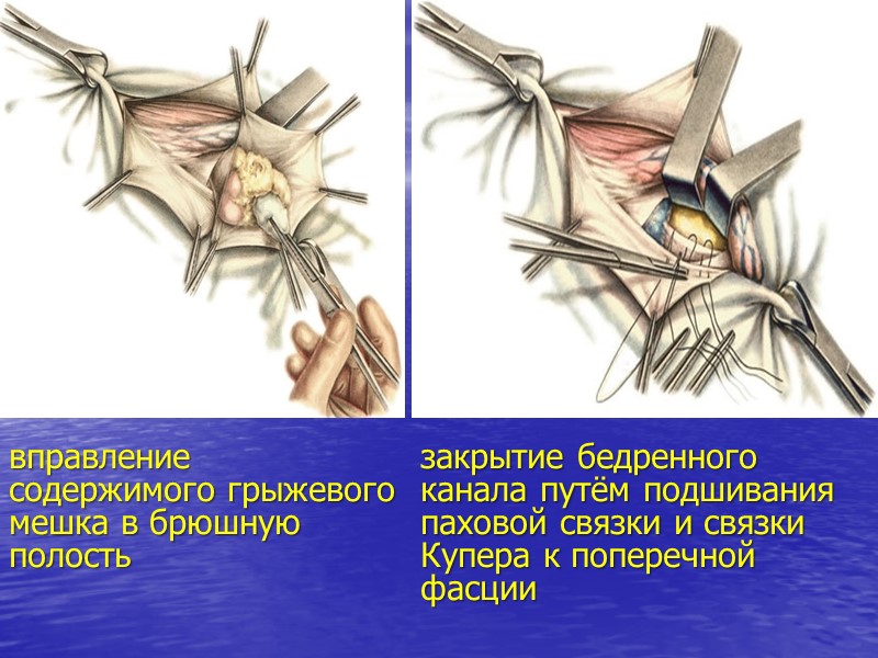 вправление  содержимого грыжевого мешка в брюшную полость закрытие бедренного канала путём подшивания паховой